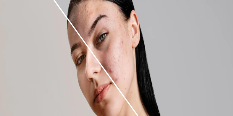 Skin Barrier