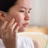 How to treat acne at home