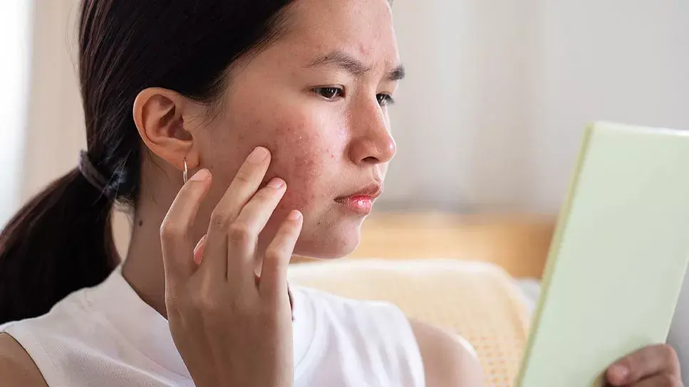 How to treat acne at home