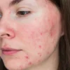 How to Repair Your Skin Barrier Fast