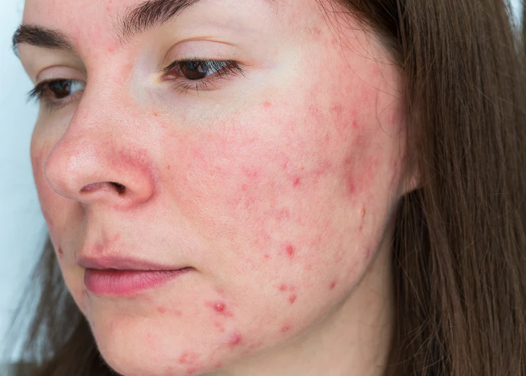 How to Repair Your Skin Barrier Fast