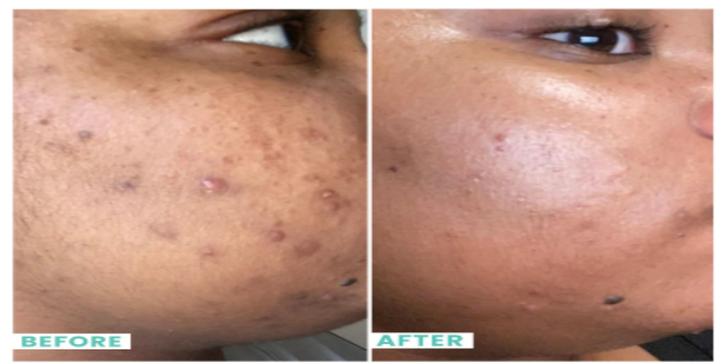 Effects of vitamin c serum on skin