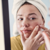 acne treatments